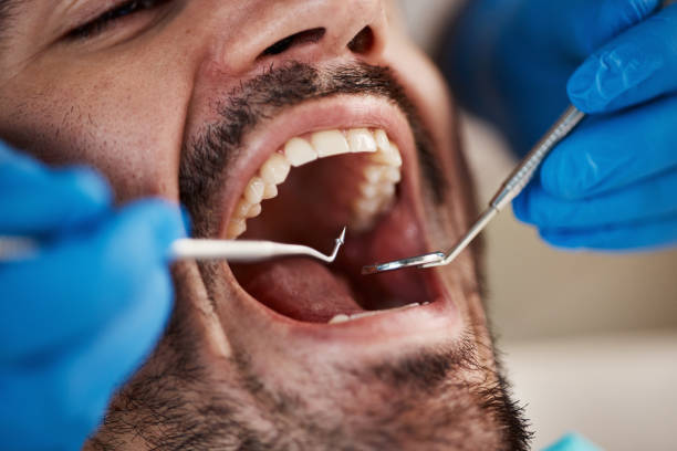 Best Emergency Tooth Extraction in Sissonville, WV